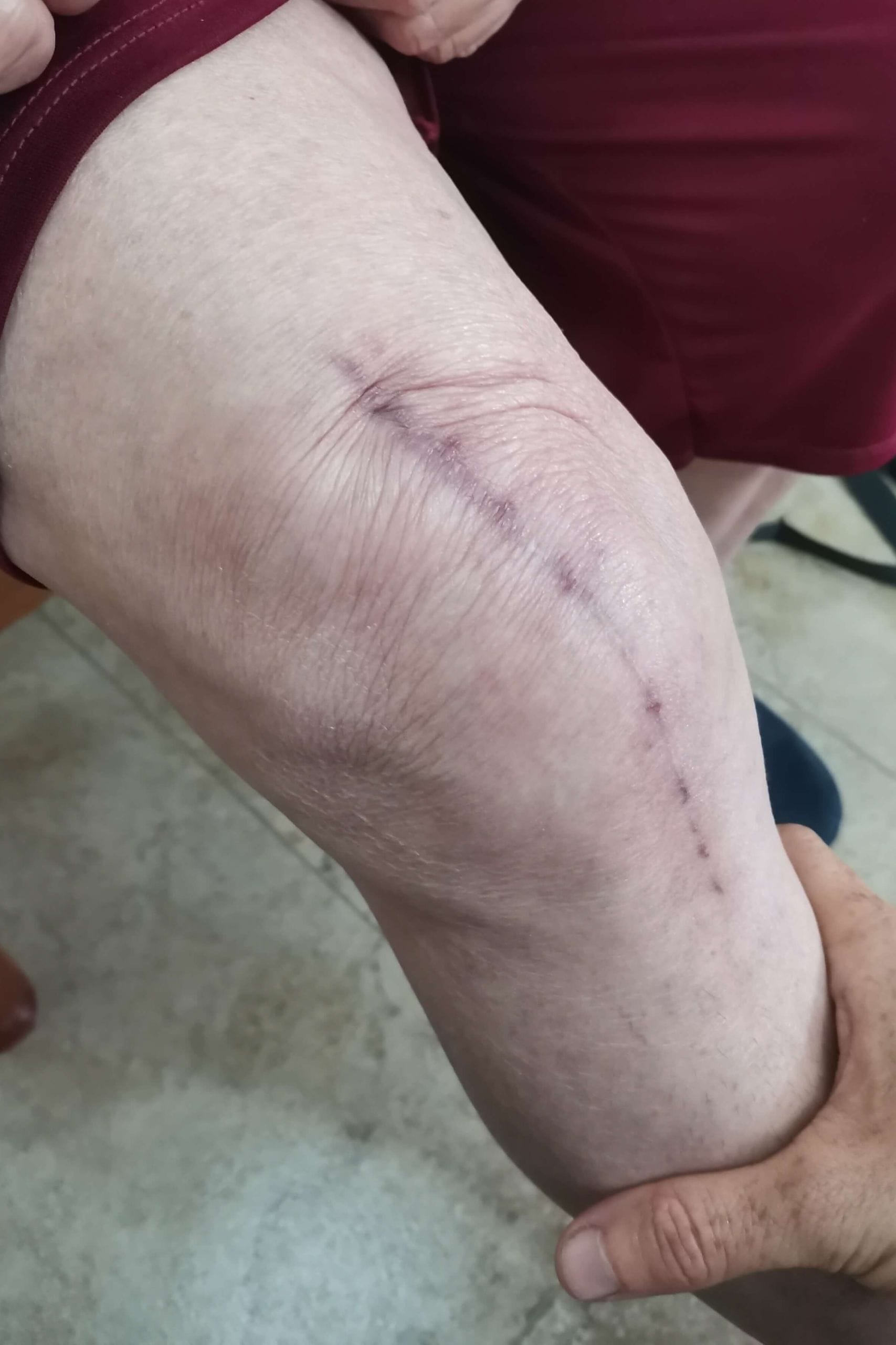 Cicatriz de operación de prótesis de rodilla en proceso de recuperación